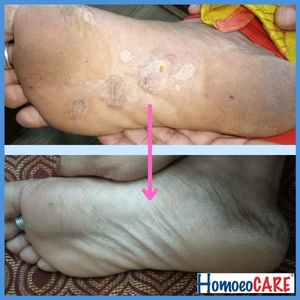Homeopathic treatment for Psoriasis foot